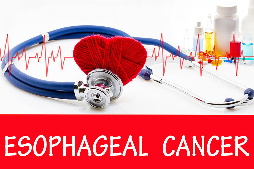 Esophageal cancer &#8211; Signs, causes, and management